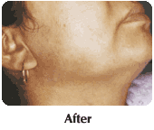 Irsutismo alla guancia - Dopo il trattamento